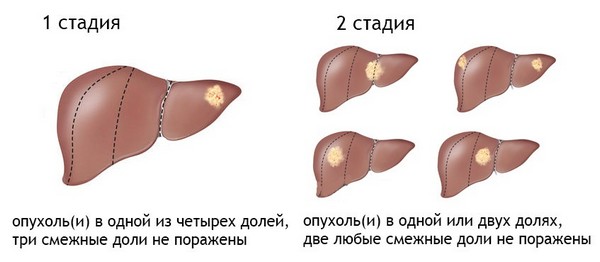 1 – 2  стадии рака печени