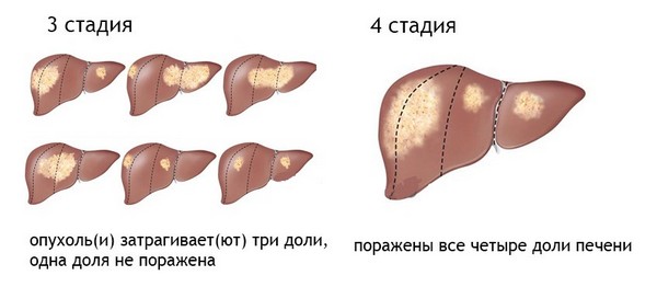 3 – 4 стадии рака печени
