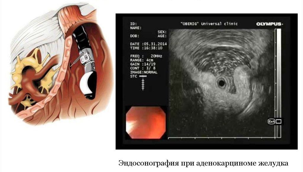эндосонография желудка
