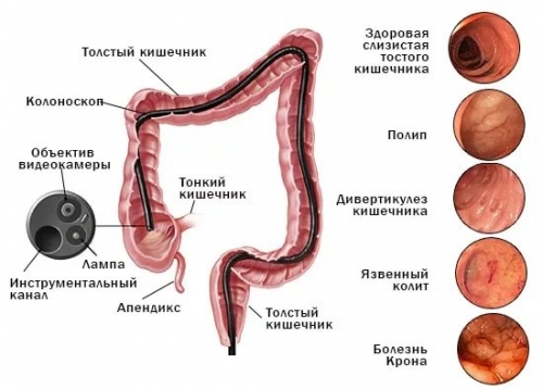 видеоколоноскопия кишечника