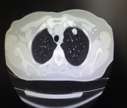 Периферическая опухоль верхней доли левого легкого (компьютерная томография)