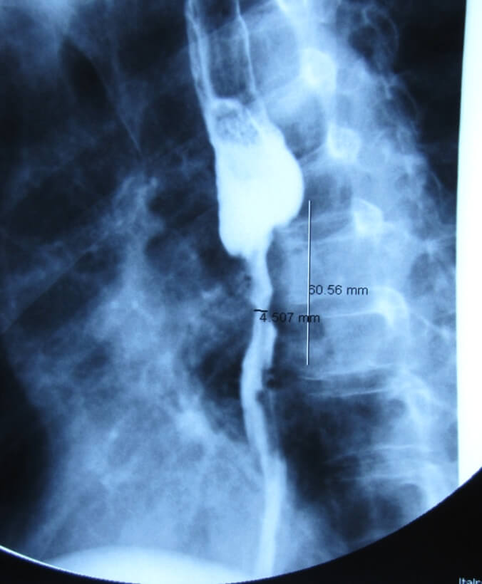 Рентгеноскопия пищевода (опухоль пищевода, среднегрудной отдел)